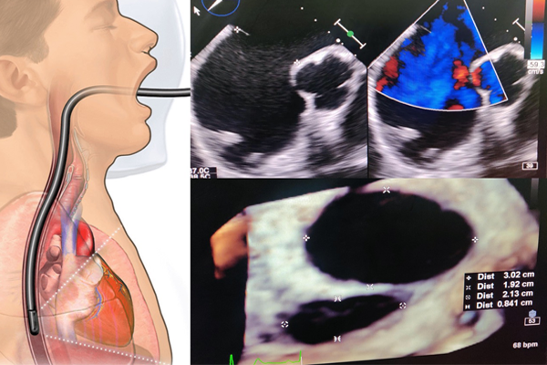 2-D & 3-D Trans-oesophageal Echocardiogram (TEE)